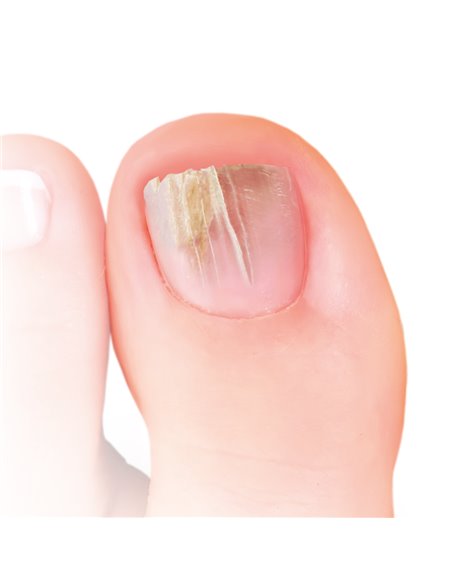 Nailner Pincel 2 En 1 Antihongos 5 Mililitros Nailner