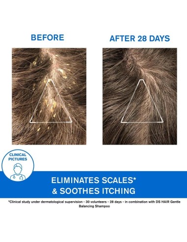 Ds Champu Tratamiento Queratorreductor 150Ml. de Uriage